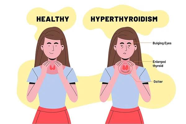 Hypothyroidism (symptoms,Tests and diet plan)